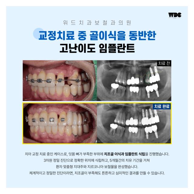 고난이도 임플란트 진료